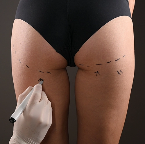 closeup-view-female-buttocks-marked-plastic-operation copiar